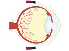 Behandeling glaucoom